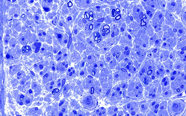 5B5 (Case 5) Plastic 7