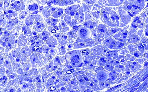 5B6 (Case 5) Plastic 11