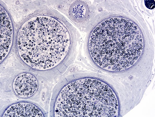 1A1 Amiodarone (Case 1) Plastic 1