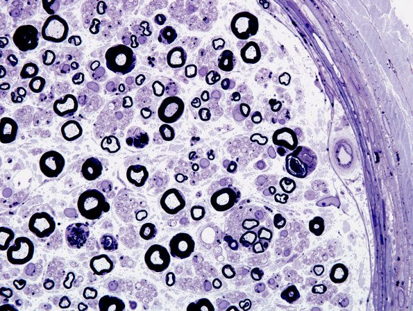 1A10 Amiodarone (Case 1) Plastic 9
