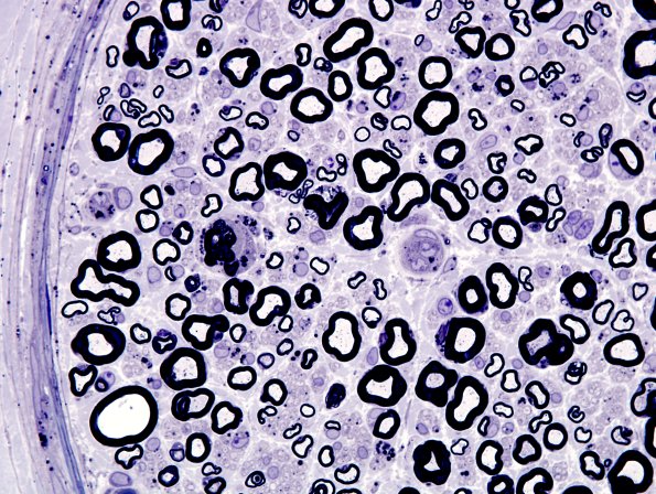 1A11 Amiodarone (Case 1) Plastic 10