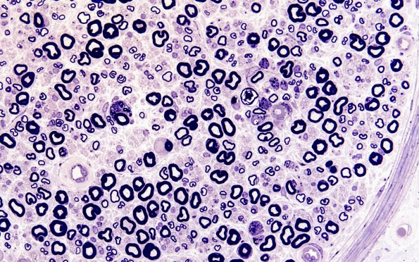 1A12 Amiodarone (Case 1) Plastic 60X 1