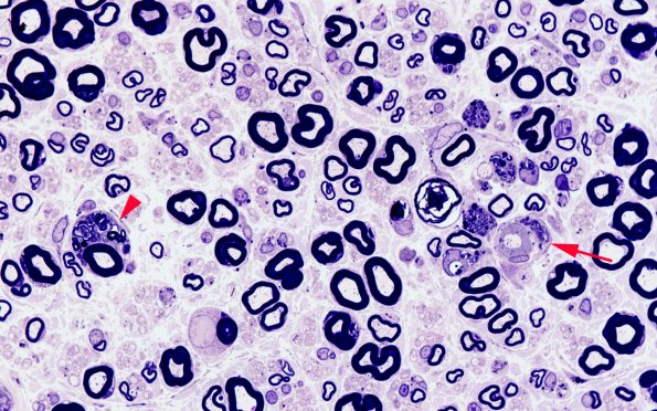 1A13 Amiodarone (Case 1) Plastic 100X 1 copy