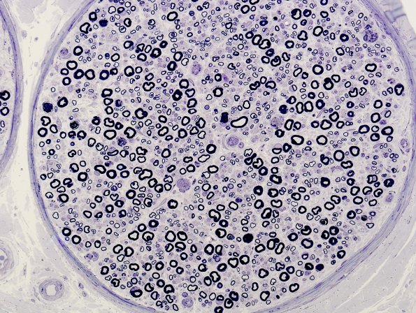 1A4 Amiodarone (Case 1) Plastic 13