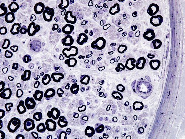 1A8 Amiodarone (Case 1) Plastic 6