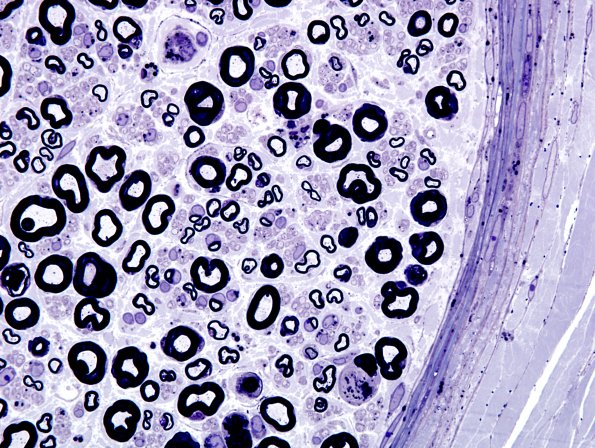 1A9 Amiodarone (Case 1) Plastic 7