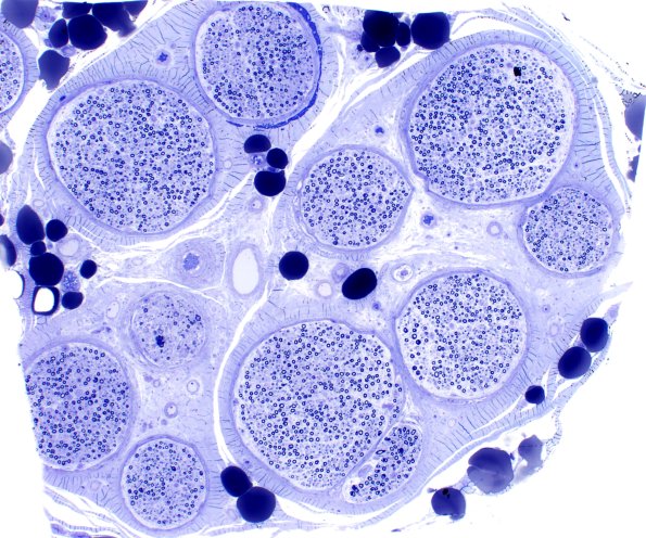 2A1 Amiodarone (Case 2) Plastic 4X 1
