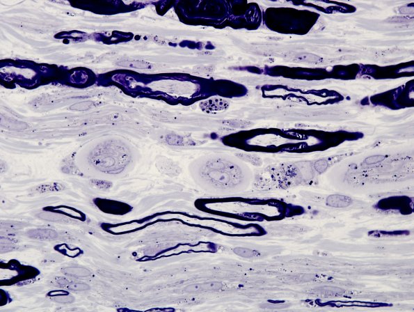 2A11 Amiodarone neuropathy (Case 2 Plastic 5