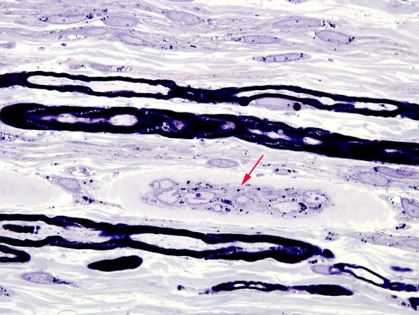 2A12 Amiodarone neuropathy (Case 2) Plastic 6 copy