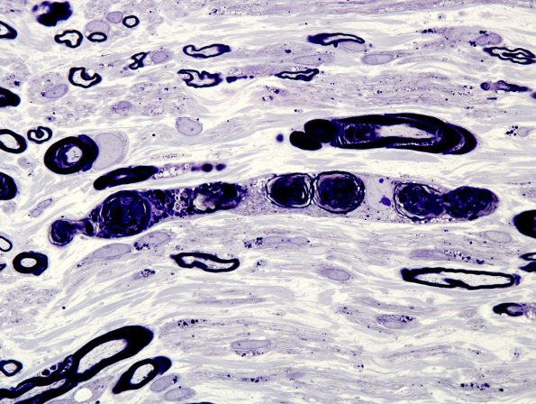 2A13 Amiodarone neuropathy (Case 2) Plastic 1