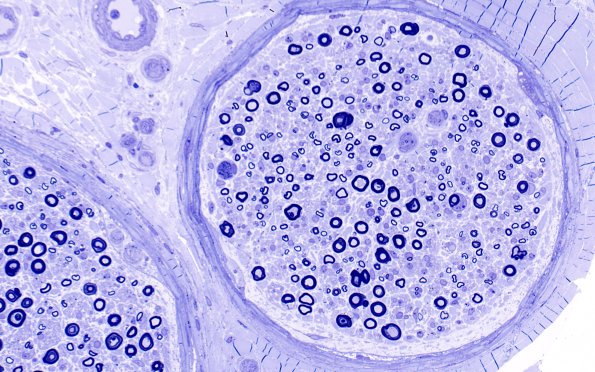 2A3 Amiodarone (Case 2) Plastic 40X 2