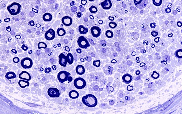 2A4  Amiodarone (Case 2) Plastic 100X 3