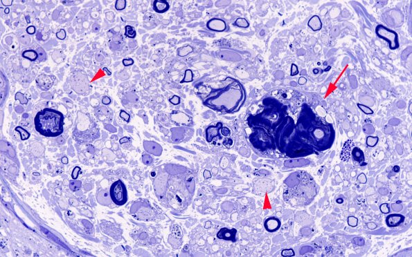 2A6 Amiodarone (Case 2) Plastic 100X 1 copy