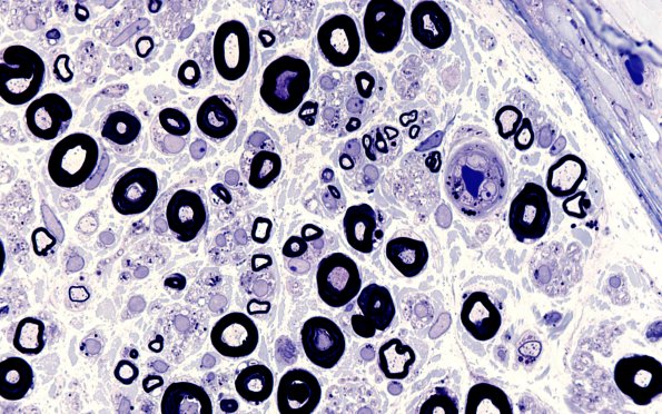 2A8 Amiodarone (Case 2) Plastic 100X 4