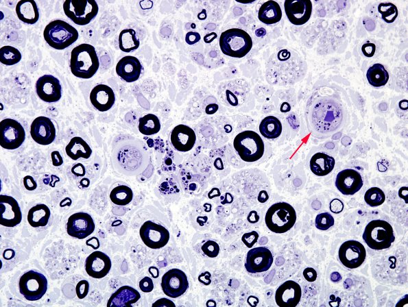 2A9 Amiodarone neuropathy (Case 2) Plastic 15 copy