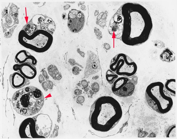 2B1 Amiodarone (Case 2) 1 - Copy copy