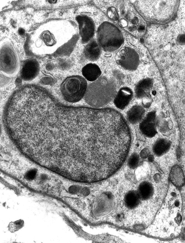 2B2 Schwann cell (Case 2) Amiodarone - Copy