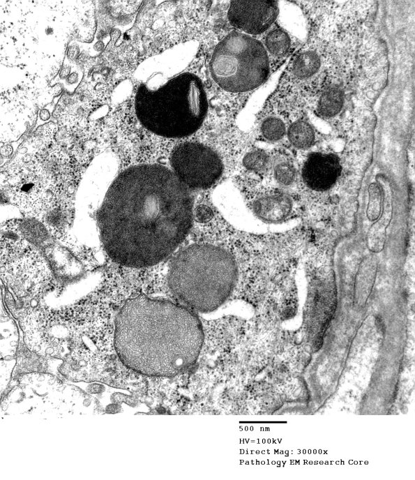 2B5 Amiodarone (Case 2)_008a - Copy