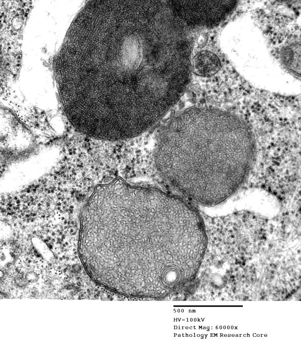 2B6 Amiodarone (Case 2)_009a - Copy