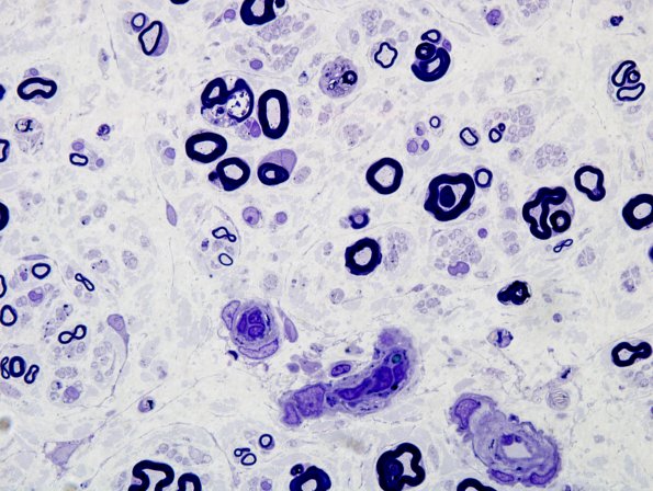 1A4 Chloroquine NP (Case 1) Plastic 3