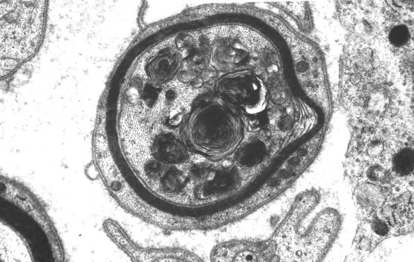 1B2 Chloroquine NP (Case 1) - Copy