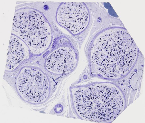 1A1 Disulfiram (Case 1) Plastic 6
