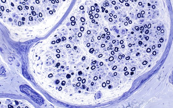 1A2 Disulfiram (Case 1) Plastic 40X 2