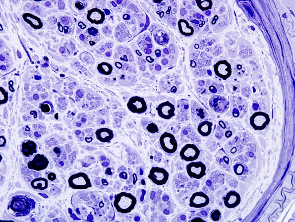 1A5 Disulfiram (Case 1) Plastic 10