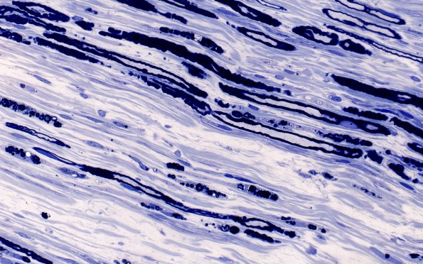 1A8 Disulfiram (Case 1) Plastic 40X 1