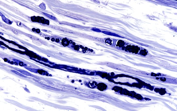 1A9 Disulfiram (Case 1) Plastic 100X 1