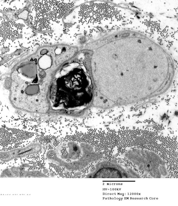 1B1 Disulfiram (Case 1) EM002 - Copy