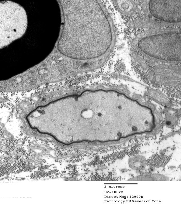 1B4 Disulfiram (Case 1) EM009 - Copy