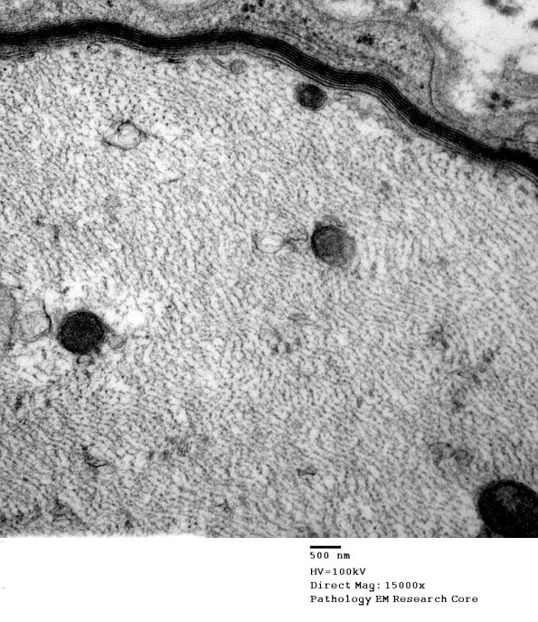 1B5 Disulfiram (Case 1) EM011 - Copy