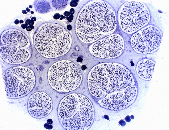 1A1 Fabry Dz (Case 1) 4X 2