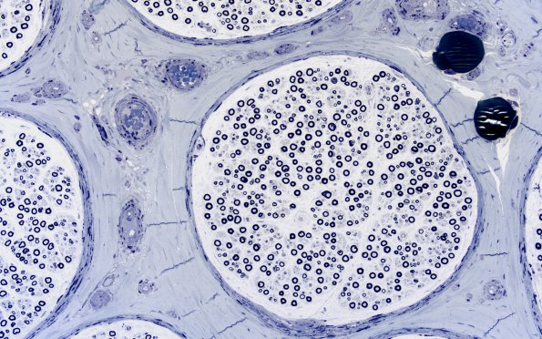 1A3 Fabry Dz (Case 1) 20X 3