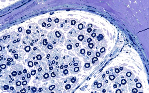 1A4 Fabry Dz (Case 1) 60X