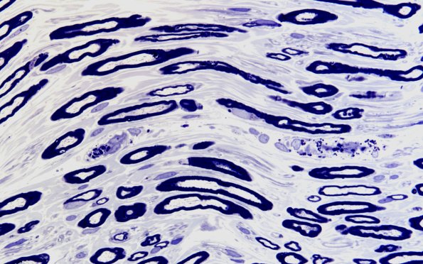 1A5 Fabry Dz (Case 1) 60X 2