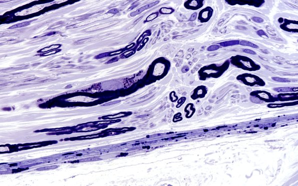 1A6 Fabry Dz (Case 1) 100X 1