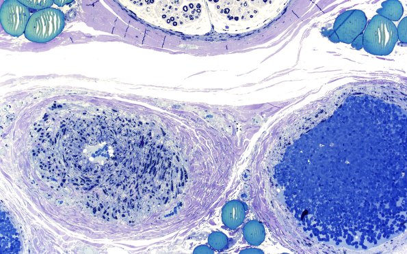 1A7 Fabry Dz (Case 1) 20X 2