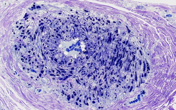 1A8 Fabry Dz (Case 1) 40X