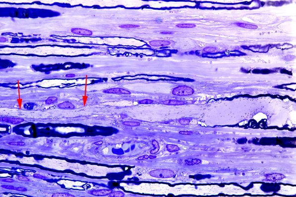 2A9 Giant Axonal Neuropathy (GAN) (Case 2) Plastic 25A | Giant Axonal ...