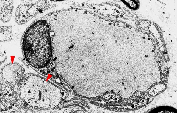 2B3 (Case 2) Giant axonal neuropathy EM 1 - Copy copy | Giant Axonal ...