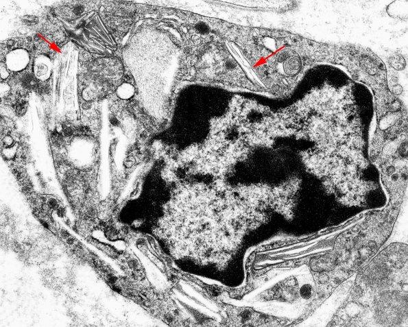 1B Krabbe copy - Copy