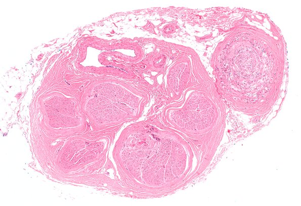 10A1 Neuroma (Case 10) H&E 4X