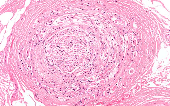 10A2 Neuroma (Case 10) H&E 20X