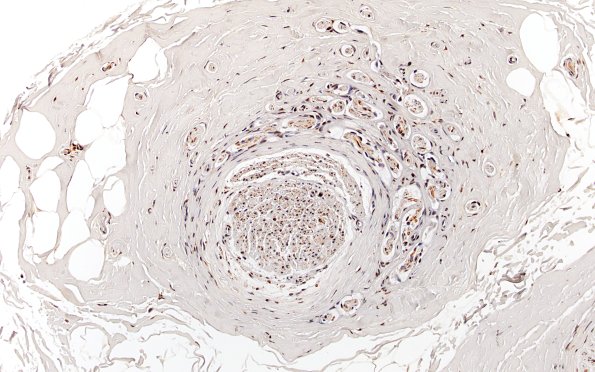 10B1 Neuroma (Case 10) NF 20X