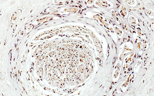 10B2 Neuroma (Case 10) NF 40X