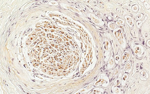 10C Neuroma (Case 10) S100 40X