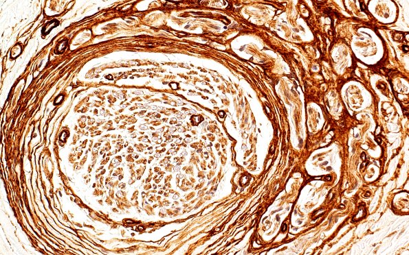 10D Neuroma (Case 10) CollIV 40X