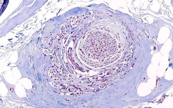 10E Neuroma (Case 10) TRI 20X